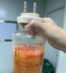 成都水动力吸脂手术要做多久？